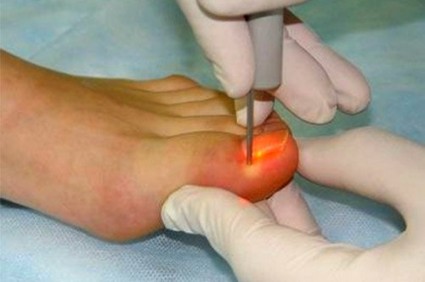 На сегодняшний день существует много методов терапии вросшего ногтя