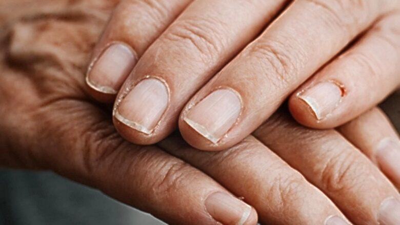 разновидности дистрофии ногтей